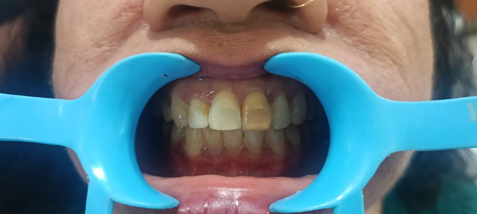 Teeth Before Crown Restoration
