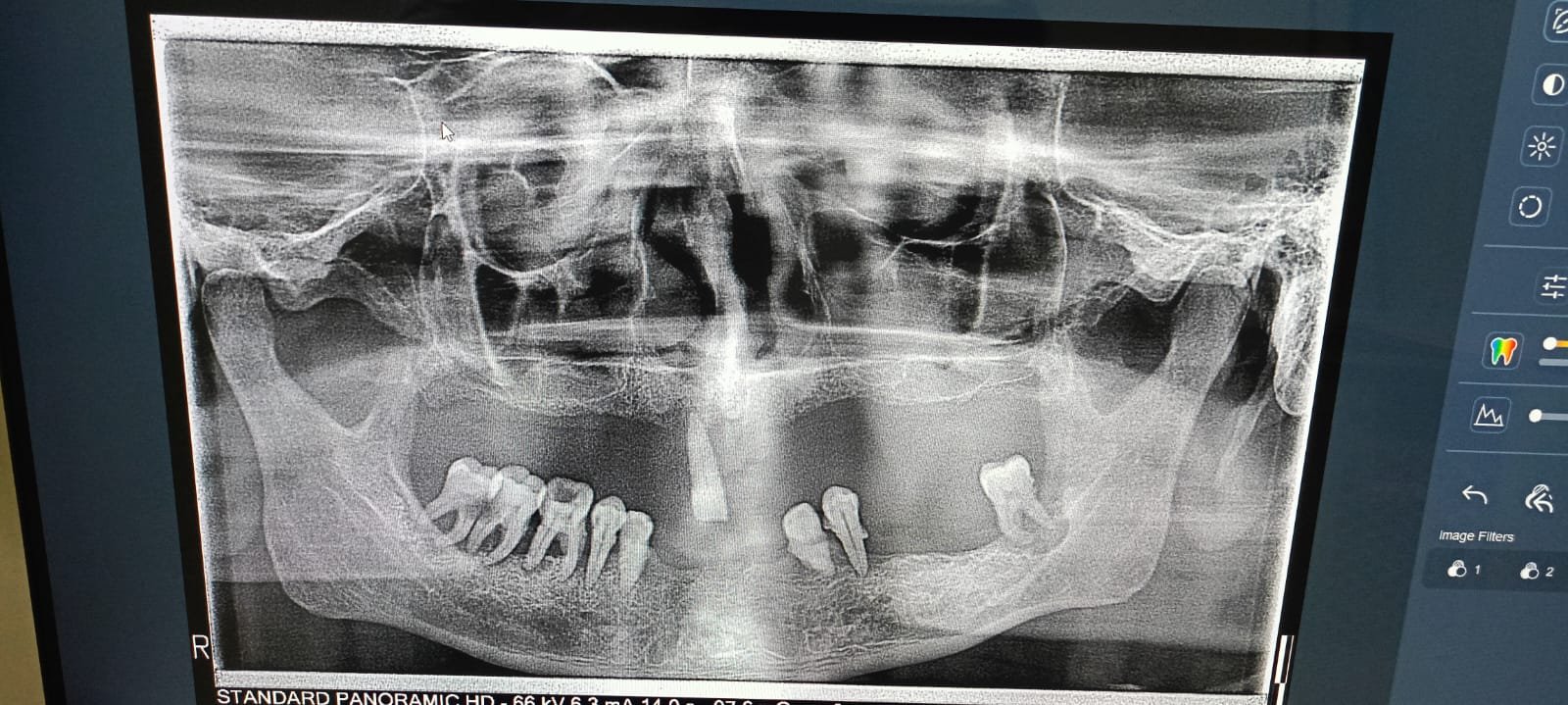 Laser Smile Makeover Suite