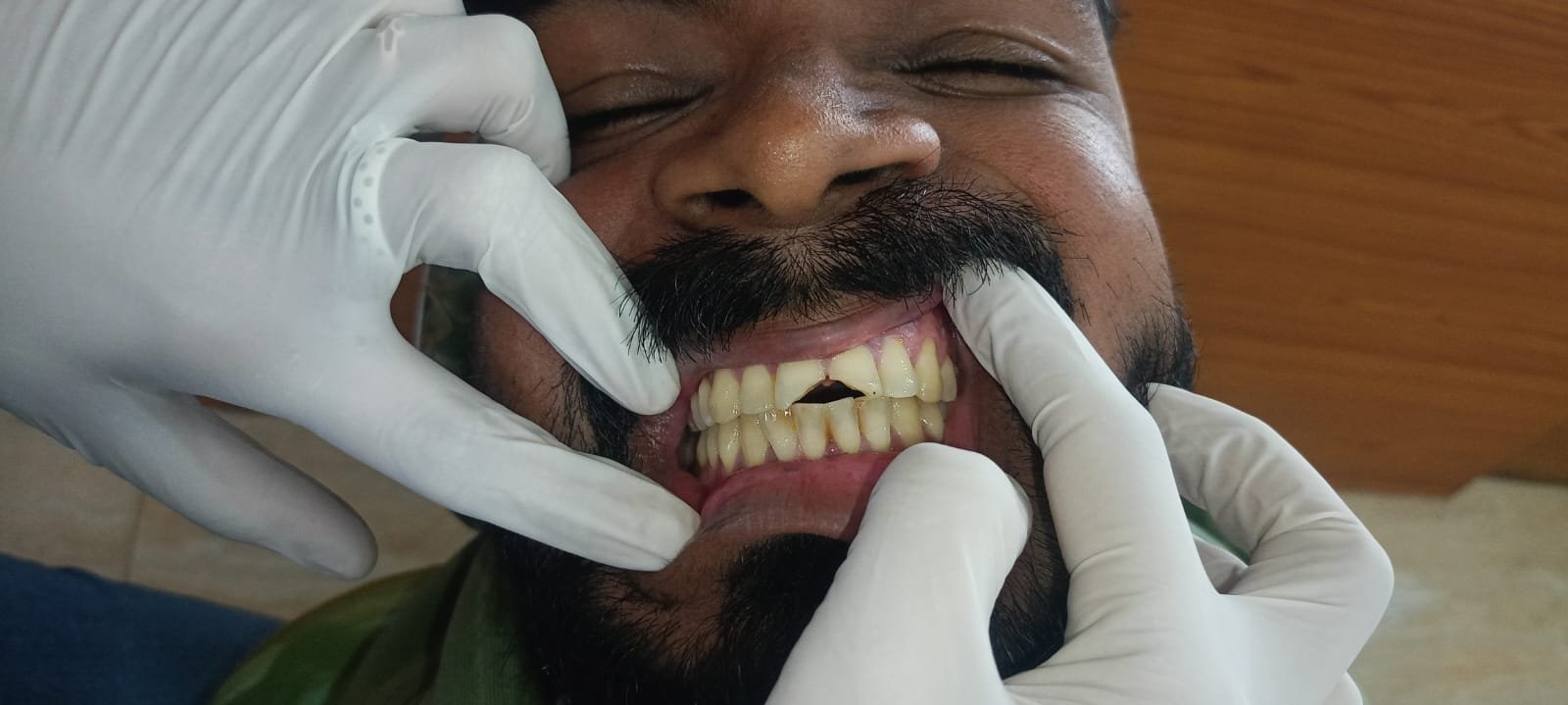 Teeth Before Dental Implants