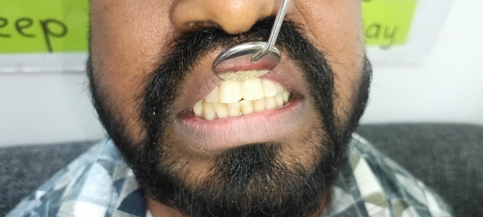 Teeth After Implants in 2 Days