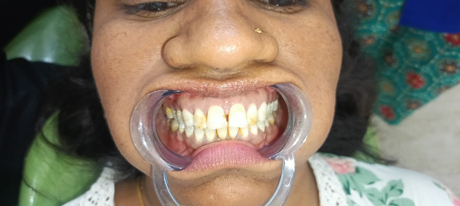 Teeth After Crown Restoration