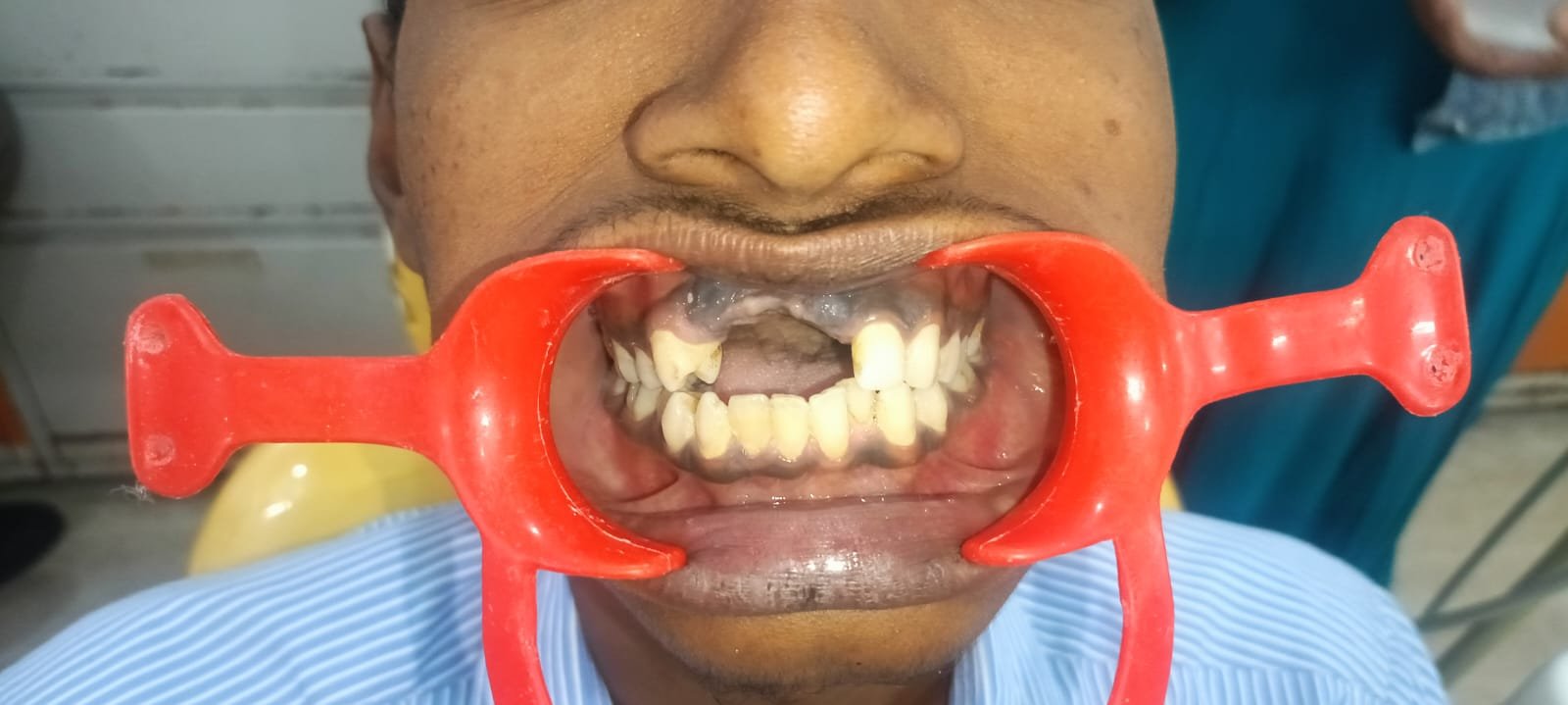 Teeth Before Veneers & Digital Smile Design