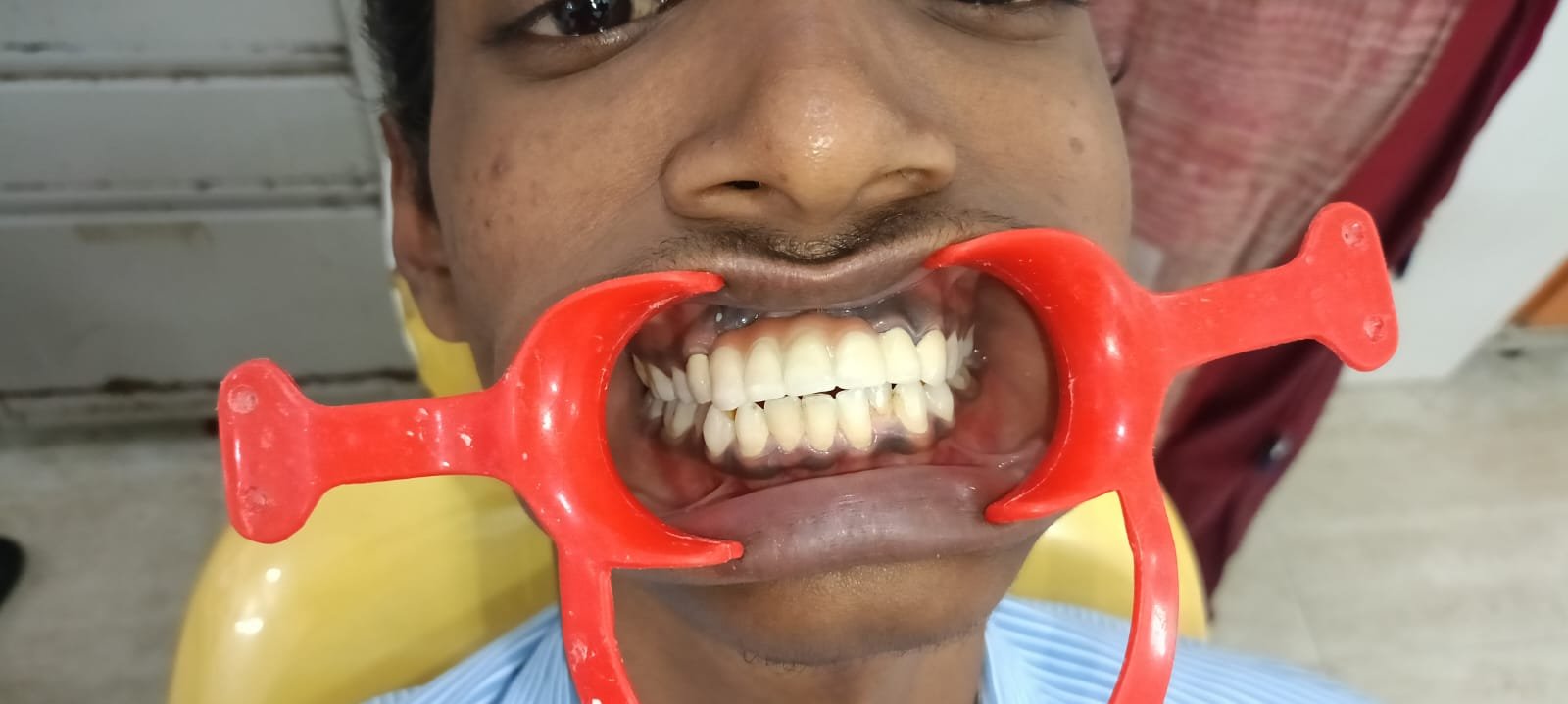 Teeth After Porcelain Veneers