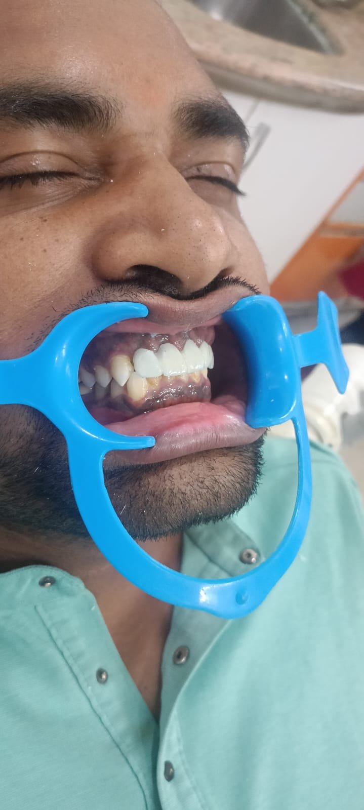 Teeth After Smile Design