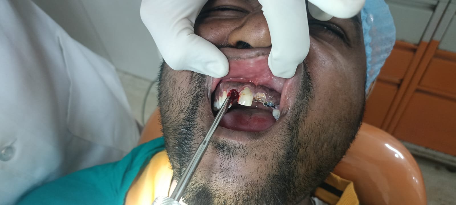 Teeth Before Laser Cleaning