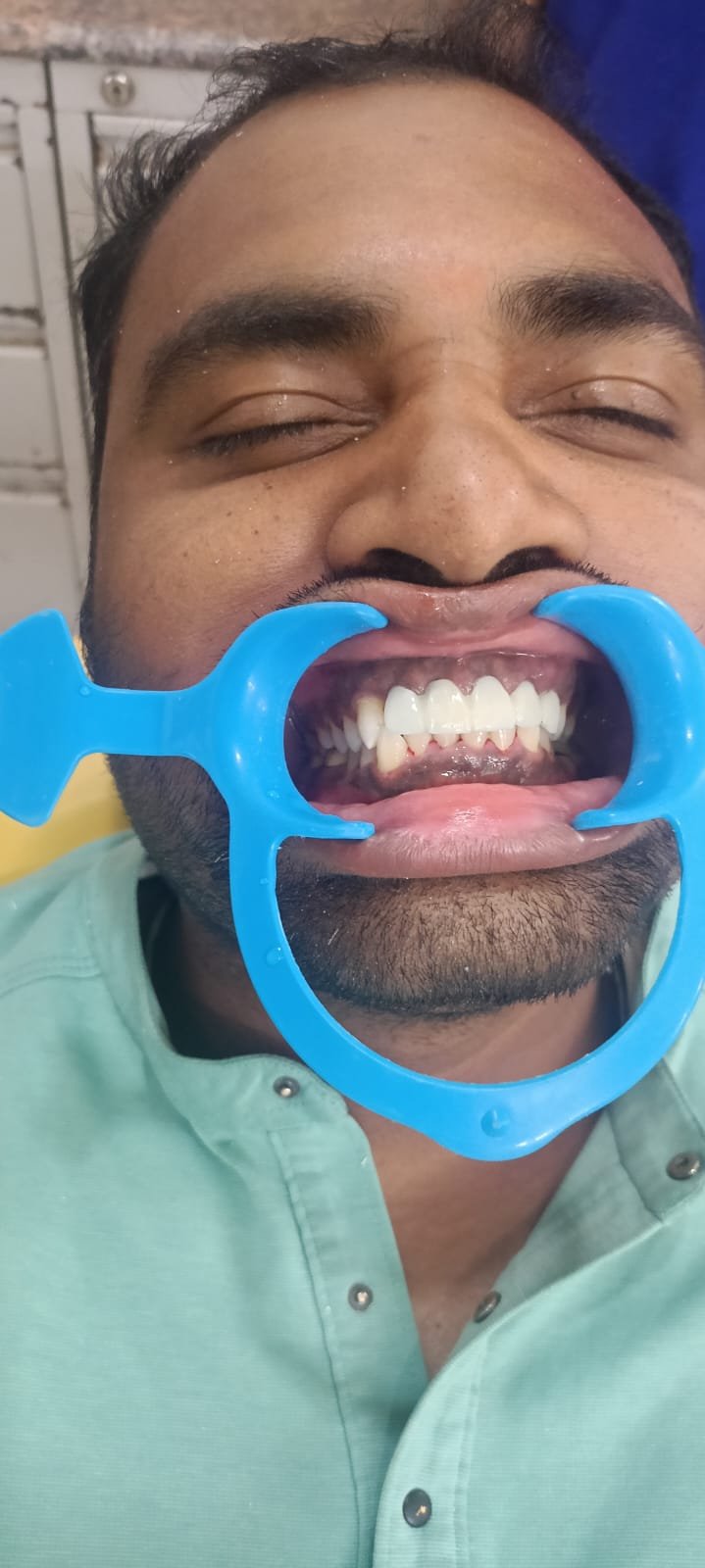 Teeth After Cleaning & Polishing