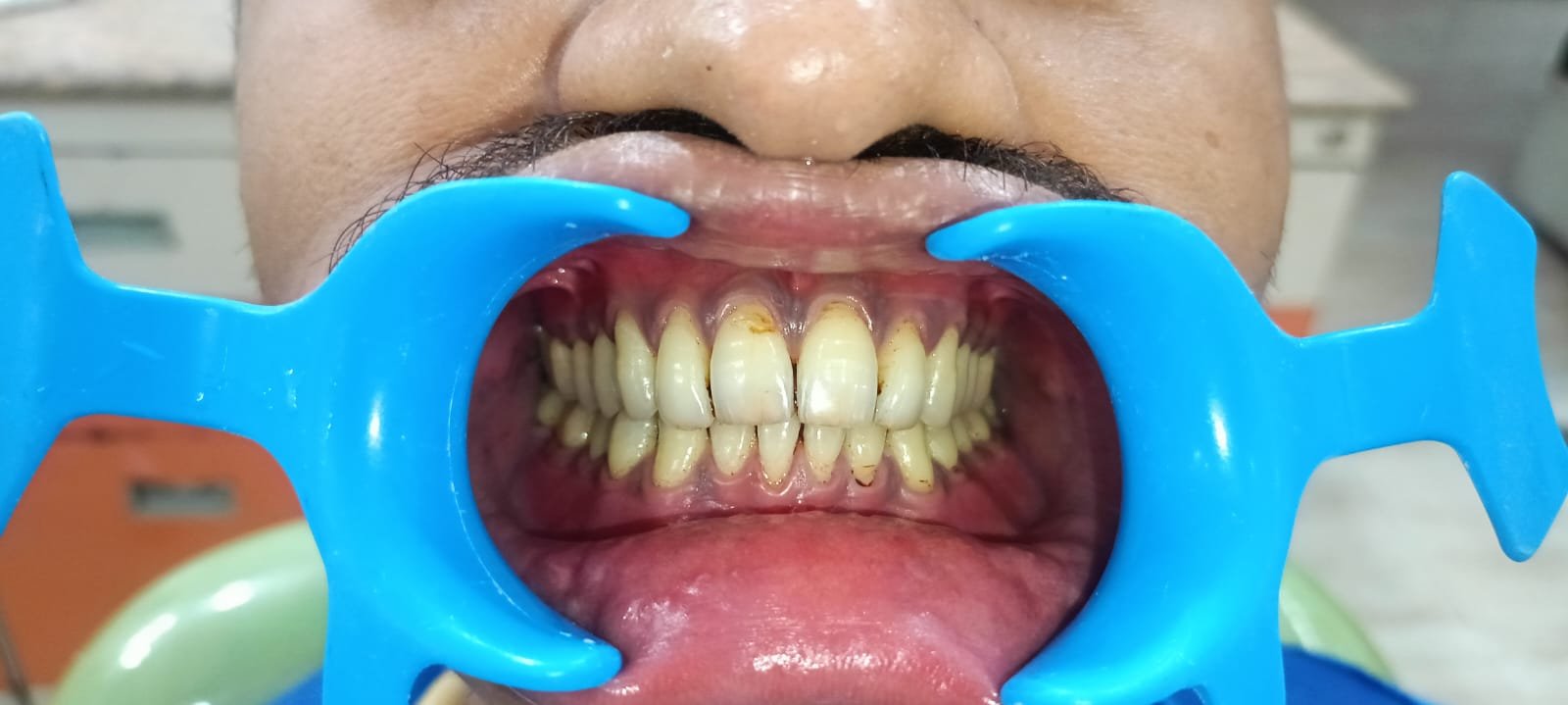 Teeth After Clear Aligners