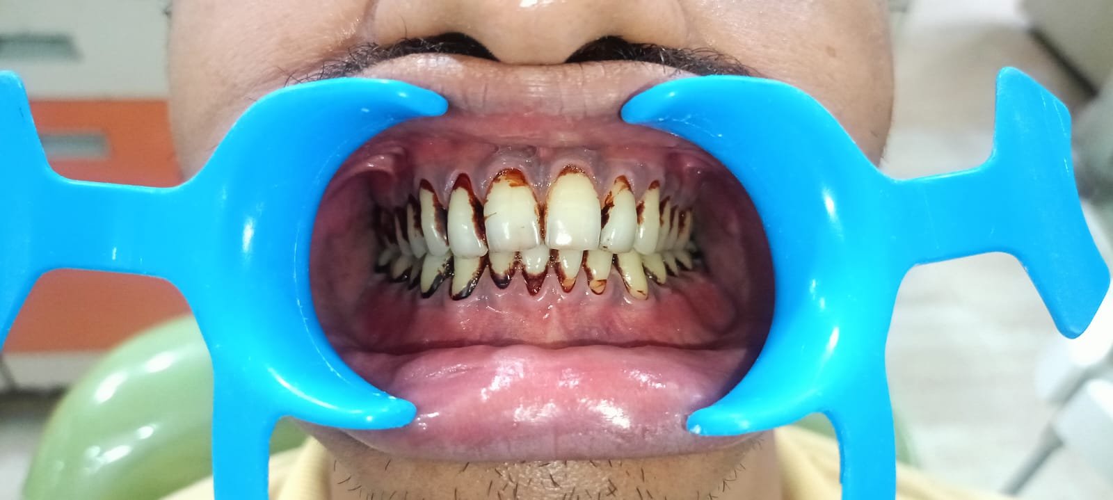 Teeth Before Clear Aligners
