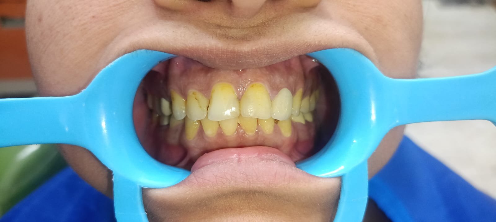 Teeth Before Laser Whitening