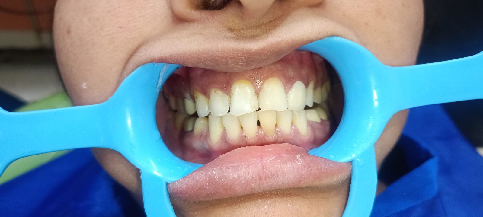 Teeth After Laser Whitening