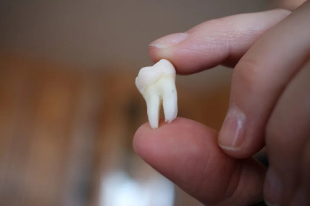 Wisdom Tooth Removal