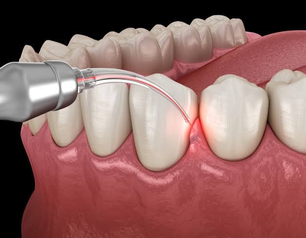 Laser Gum Surgery