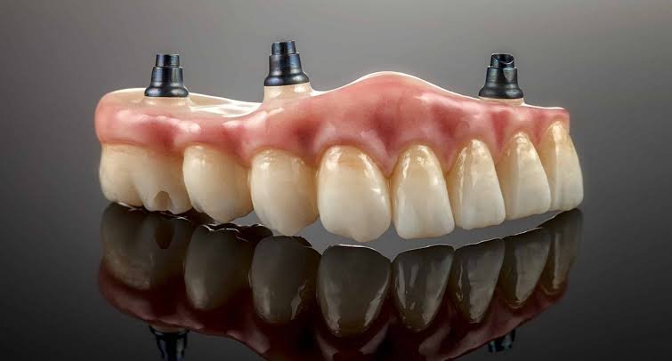 Implant Supported Dentures