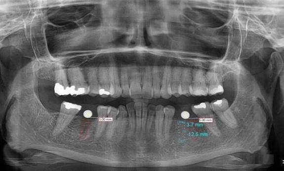 Digital Radiography and OPG