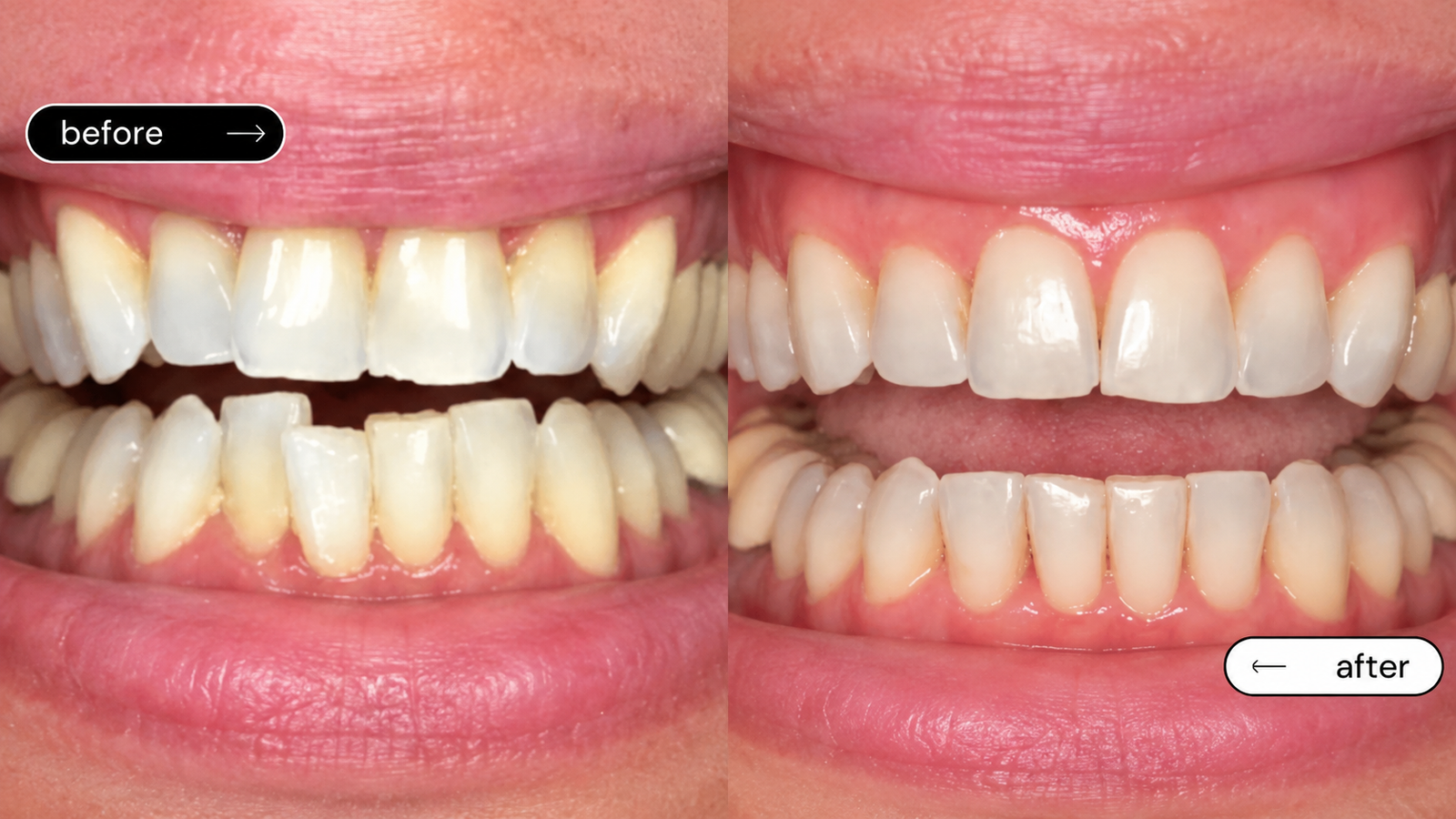 Straightening Teeth Without Premium Price
