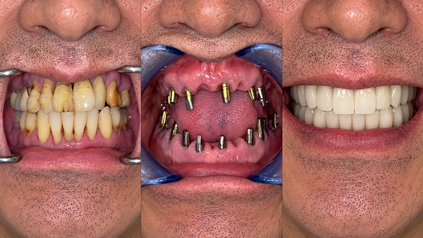 Fixed Teeth in 48 Hours Dental Implants