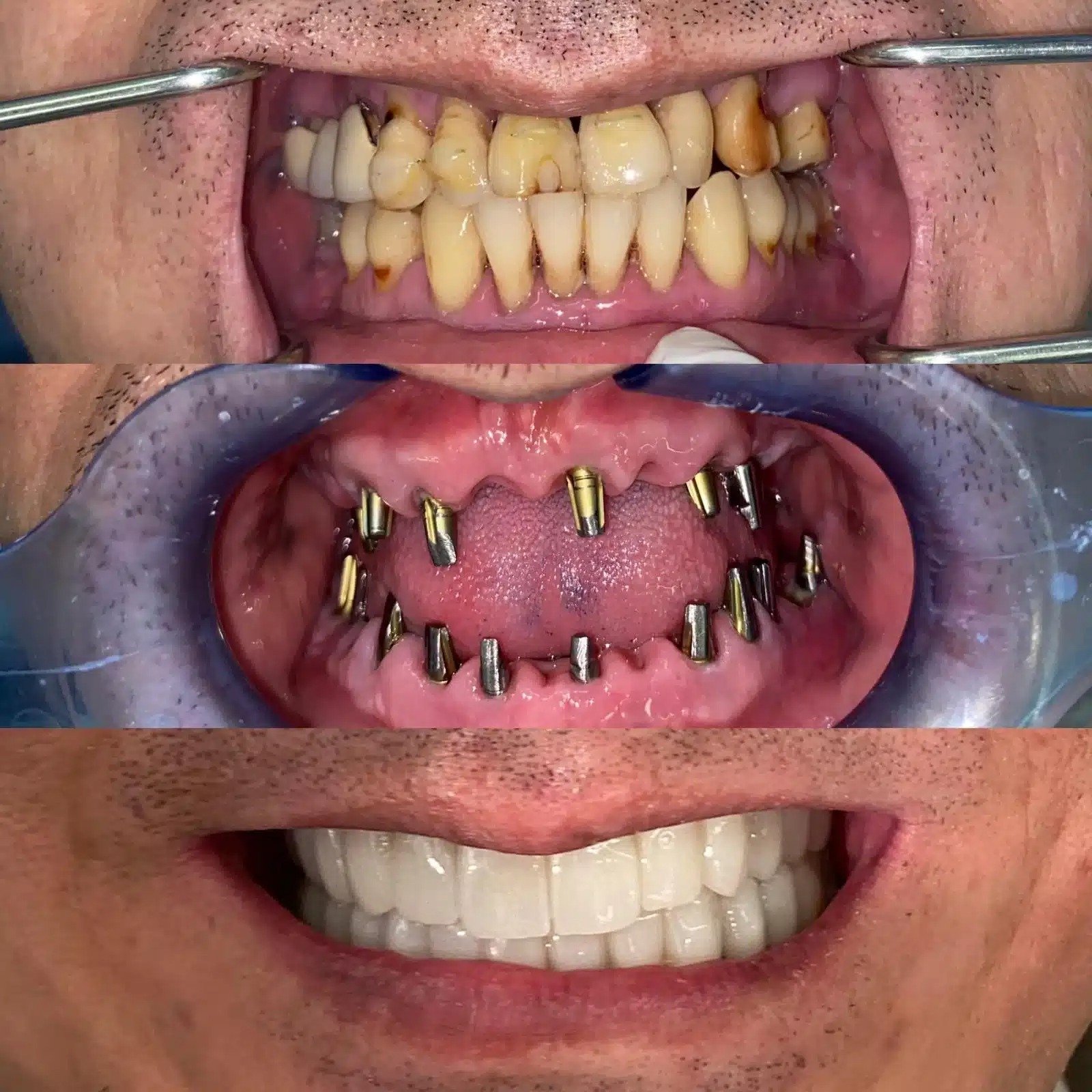 Fixed Teeth in 48 Hours Mobile