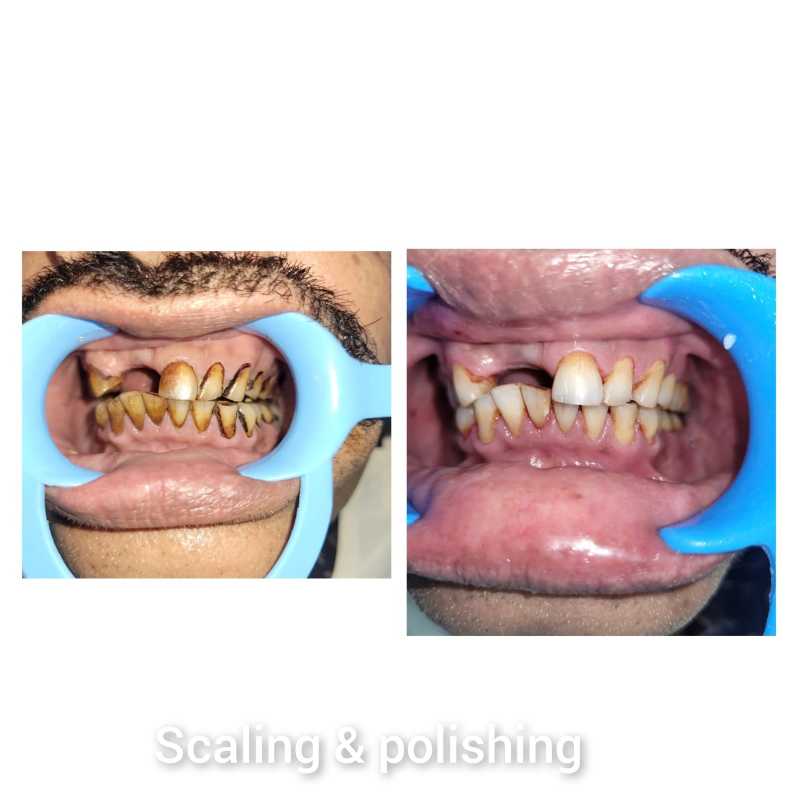 Scaling and Polishing Before and After