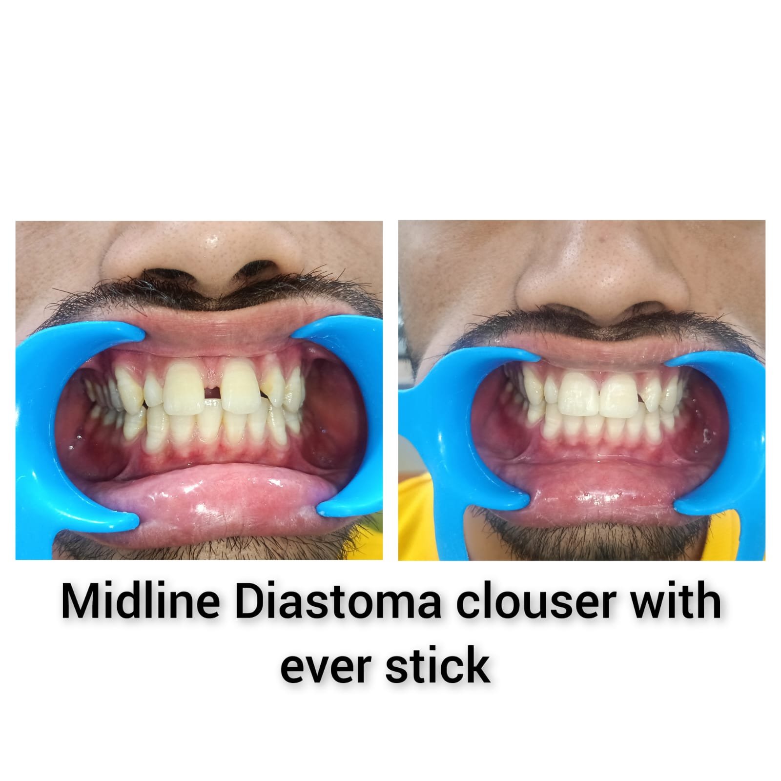 Midline Diastema Closure with EverStick Before and After