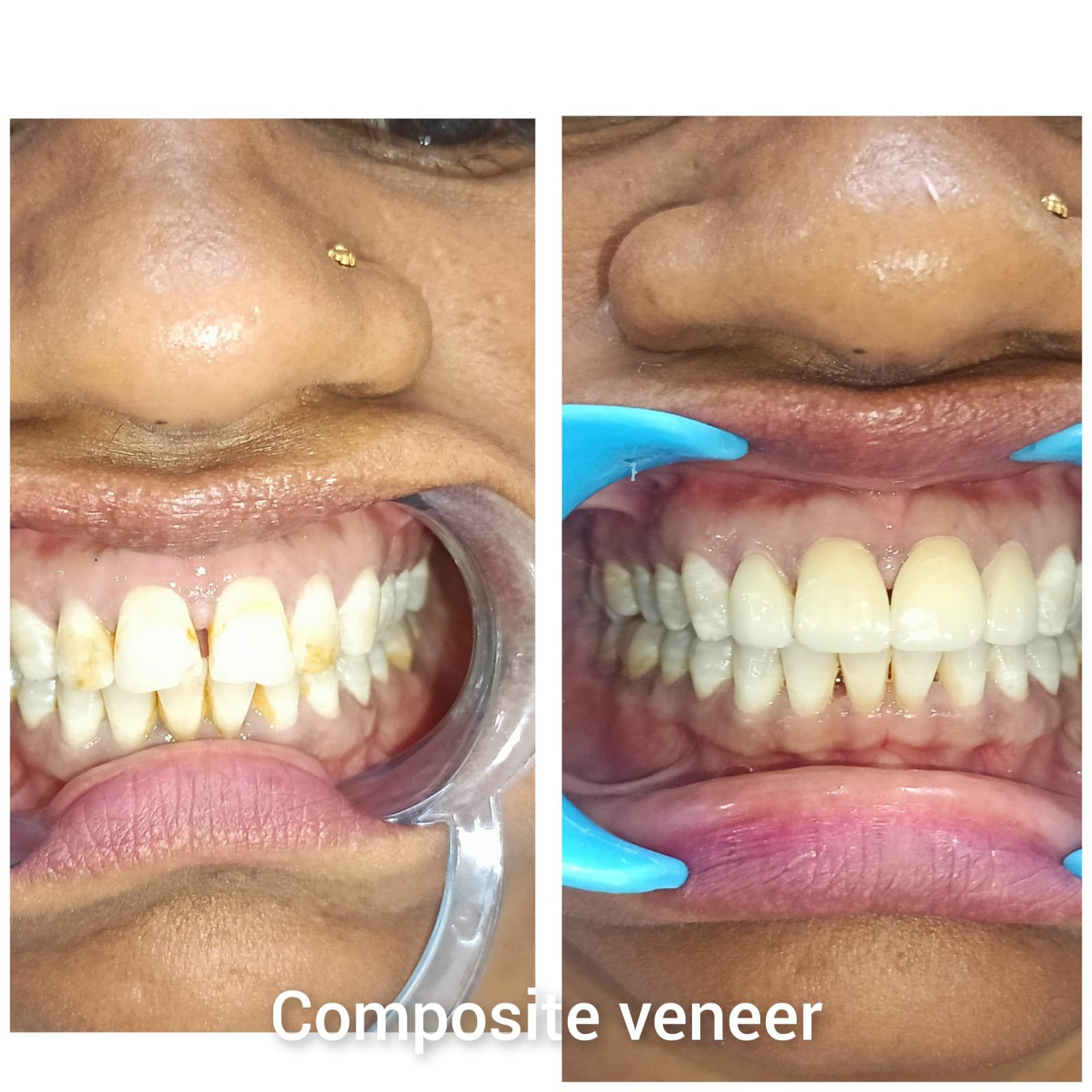 Composite Veneer Before and After