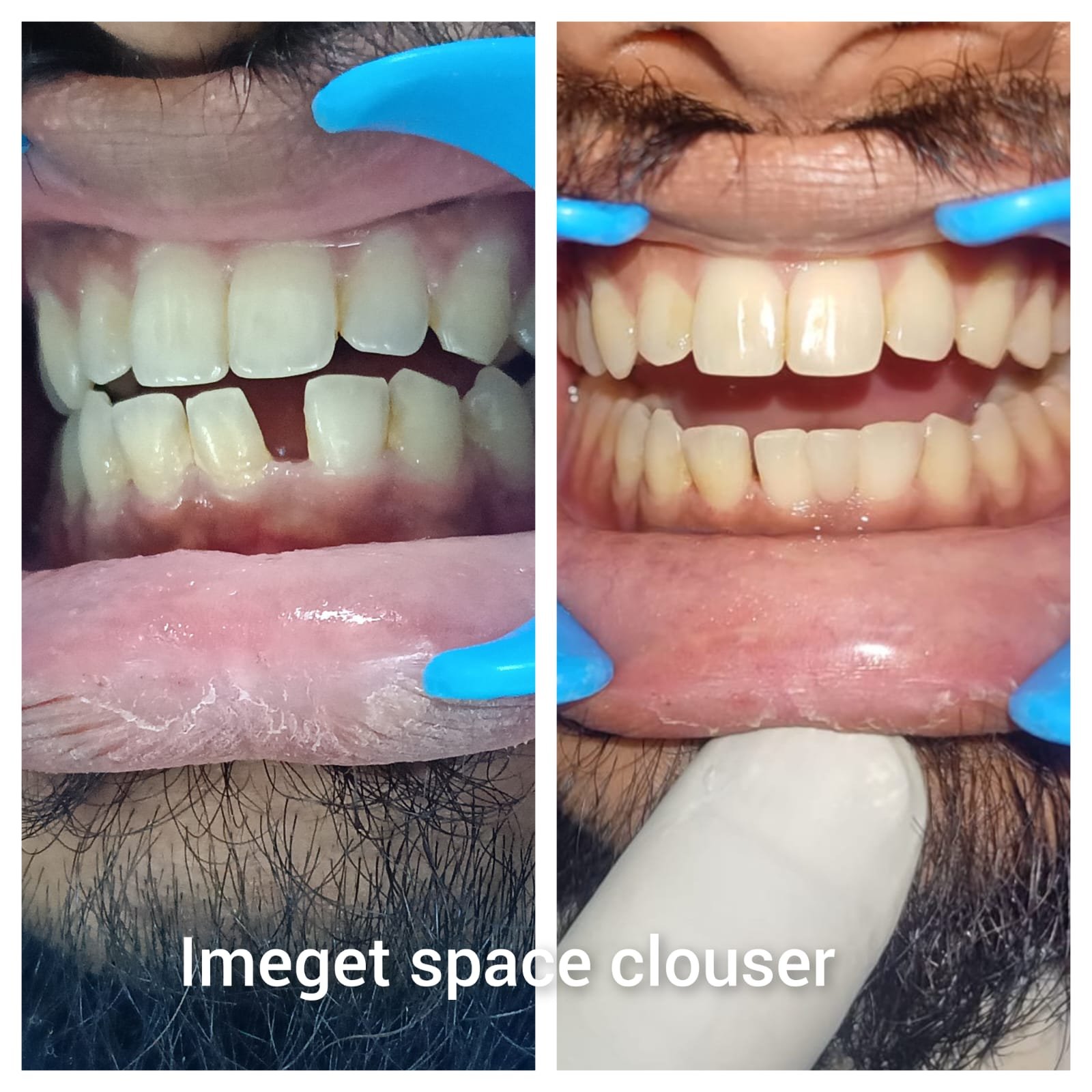 Immediate Space Closure Before and After