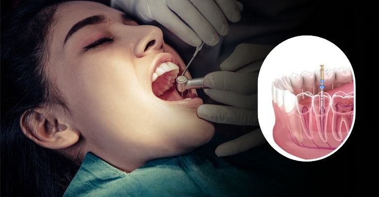 Root Canal Treatment