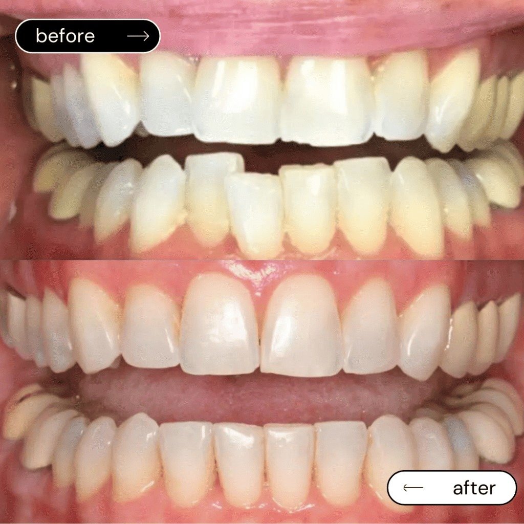 Straightening Teeth Without Premium Price Mobile